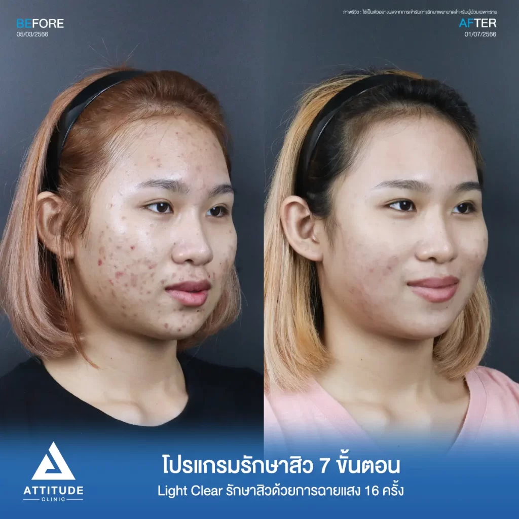 รีวิวรักษาสิวคุณหมวย ด้วยการฉายแสง Light Clear 7 ขั้นตอน จำนวน 16 ครั้ง รักษาสิวอักเสบ สิวอุดตัน และรอยสิวทั่วใบหน้าที่ 𝗔𝘁𝘁𝗶𝘁𝘂𝗱𝗲 𝗖𝗹𝗶𝗻𝗶𝗰