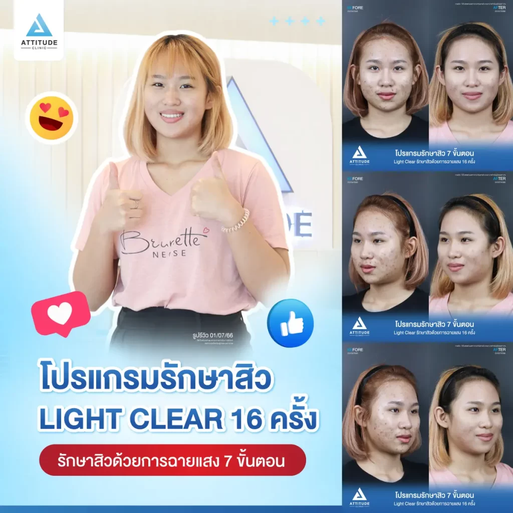 รีวิวรักษาสิวคุณหมวย ด้วยการฉายแสง Light Clear 7 ขั้นตอน จำนวน 16 ครั้ง รักษาสิวอักเสบ สิวอุดตัน และรอยสิวทั่วใบหน้าที่ 𝗔𝘁𝘁𝗶𝘁𝘂𝗱𝗲 𝗖𝗹𝗶𝗻𝗶𝗰