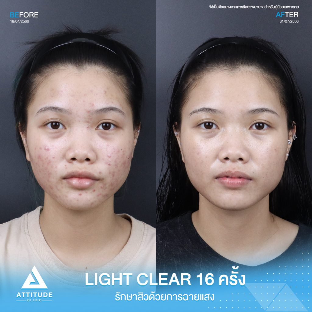 รีวิวรักษาสิวคุณปารมี ด้วยการฉายแสง Light Clear 7 ขั้นตอน จำนวน 16 ครั้ง ที่มีปัญหาสิวอักเสบ สิวอุดตัน รอยแดงจากสิว หลังรักษาสิวหาย มั่นใจมากขึ้นจริง