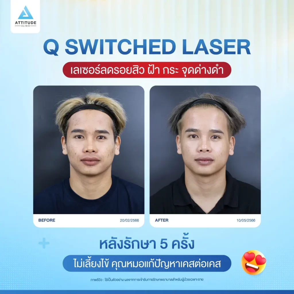 ข้อมูลครบ! Q Switched Laser พารู้จักเลเซอร์หน้าใส รักษาฝ้า กระ จุดด่างดำ ฟื้นฟูผิวให้กระจ่างใส เรียบเนียน ไร้รอยกวนใจ Yag Q Switched Laser คืออะไร? Q Switched Laser รีวิว? Q Switched Laser กี่ครั้งเห็นผล? Q Switched Laser 1 ครั้ง ราคา?