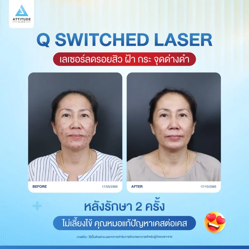 ข้อมูลครบ! Q Switched Laser พารู้จักเลเซอร์หน้าใส รักษาฝ้า กระ จุดด่างดำ ฟื้นฟูผิวให้กระจ่างใส เรียบเนียน ไร้รอยกวนใจ Yag Q Switched Laser คืออะไร? Q Switched Laser รีวิว? Q Switched Laser กี่ครั้งเห็นผล? Q Switched Laser 1 ครั้ง ราคา?