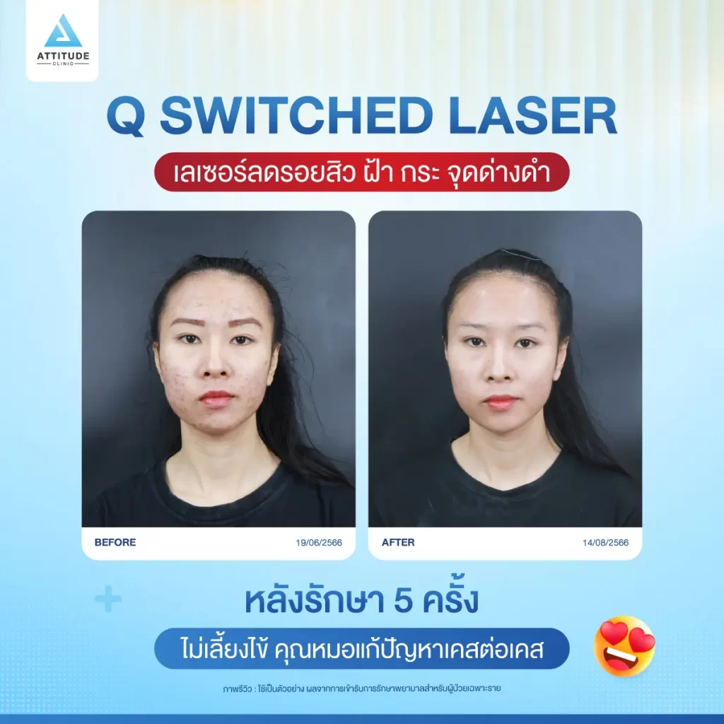 ข้อมูลครบ! Q Switched Laser พารู้จักเลเซอร์หน้าใส รักษาฝ้า กระ จุดด่างดำ ฟื้นฟูผิวให้กระจ่างใส เรียบเนียน ไร้รอยกวนใจ Yag Q Switched Laser คืออะไร? Q Switched Laser รีวิว? Q Switched Laser กี่ครั้งเห็นผล? Q Switched Laser 1 ครั้ง ราคา?
