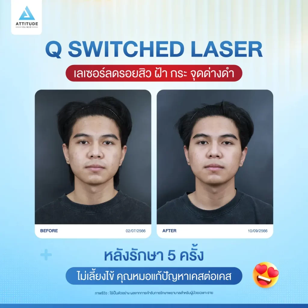ข้อมูลครบ! Q Switched Laser พารู้จักเลเซอร์หน้าใส รักษาฝ้า กระ จุดด่างดำ ฟื้นฟูผิวให้กระจ่างใส เรียบเนียน ไร้รอยกวนใจ Yag Q Switched Laser คืออะไร? Q Switched Laser รีวิว? Q Switched Laser กี่ครั้งเห็นผล? Q Switched Laser 1 ครั้ง ราคา?