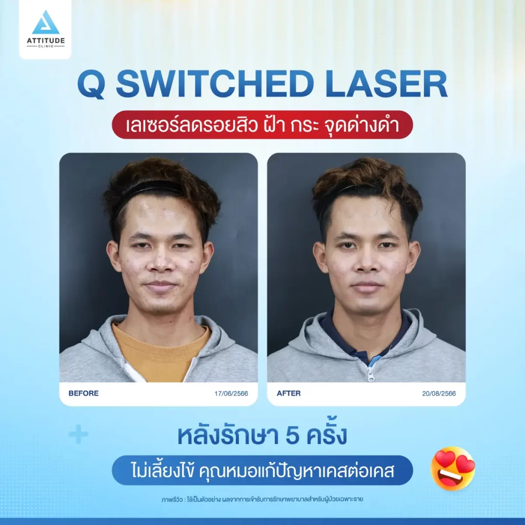 ข้อมูลครบ! Q Switched Laser พารู้จักเลเซอร์หน้าใส รักษาฝ้า กระ จุดด่างดำ ฟื้นฟูผิวให้กระจ่างใส เรียบเนียน ไร้รอยกวนใจ Yag Q Switched Laser คืออะไร? Q Switched Laser รีวิว? Q Switched Laser กี่ครั้งเห็นผล? Q Switched Laser 1 ครั้ง ราคา?