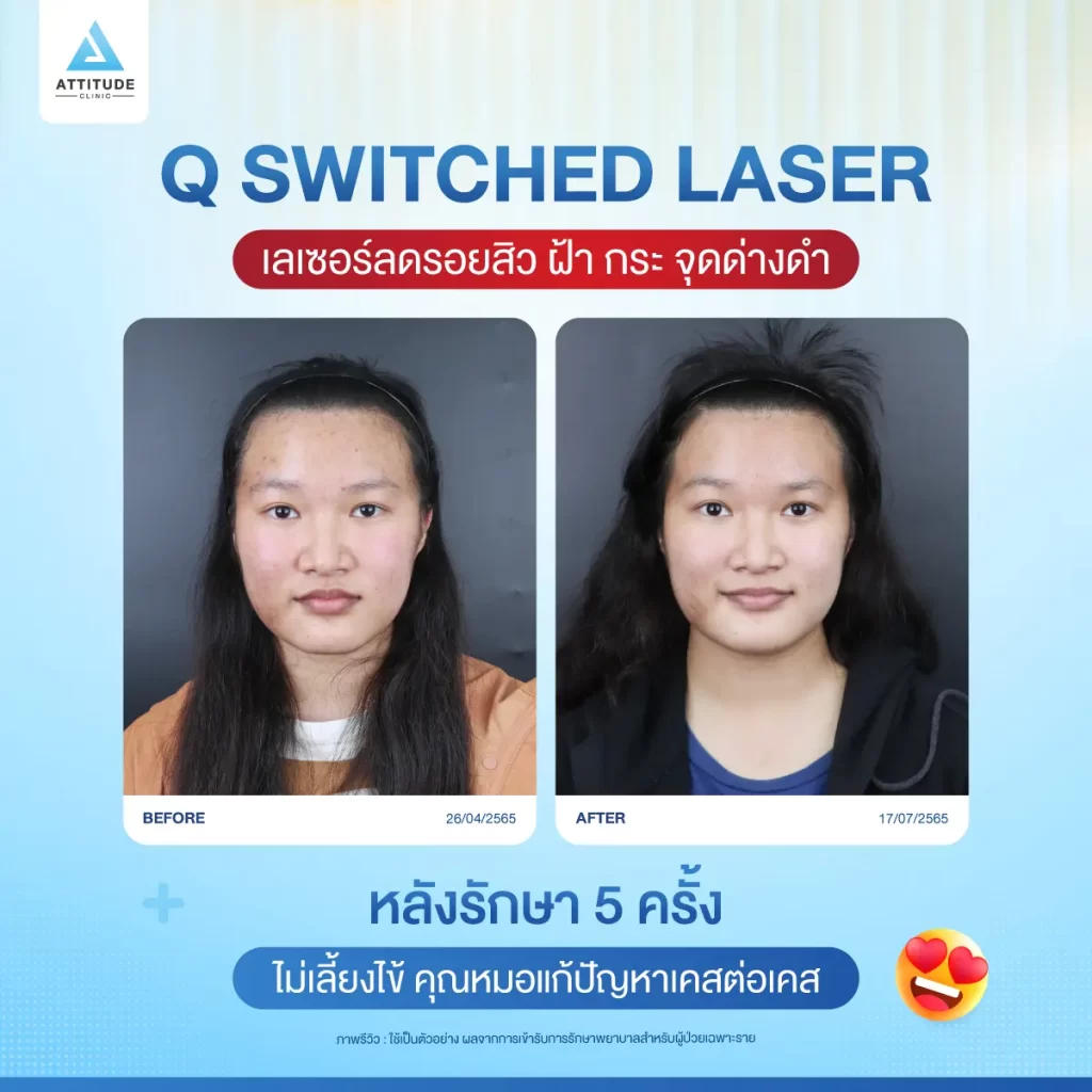 ข้อมูลครบ! Q Switched Laser พารู้จักเลเซอร์หน้าใส รักษาฝ้า กระ จุดด่างดำ ฟื้นฟูผิวให้กระจ่างใส เรียบเนียน ไร้รอยกวนใจ Yag Q Switched Laser คืออะไร? Q Switched Laser รีวิว? Q Switched Laser กี่ครั้งเห็นผล? Q Switched Laser 1 ครั้ง ราคา?