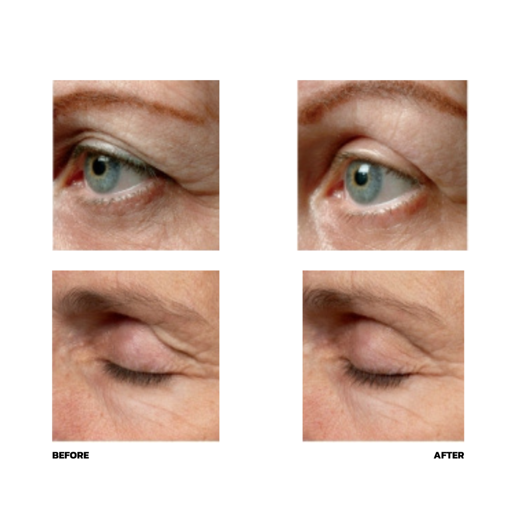 รู้ก่อนตัดสินใจทำ Thermage FLX เทคโนโลยียกกระชับผิวแบบไร้แผล Thermage FLX คืออะไร ? Thermage FLX ช่วยแก้ปัญหาอะไรบ้าง ? ข้อดีของ Thermage FLX ? Thermage FLX ราคา ? Thermage เชียงรายมีไหม ? เทอมาจ เชียงราย ทำที่ไหนดี ?
