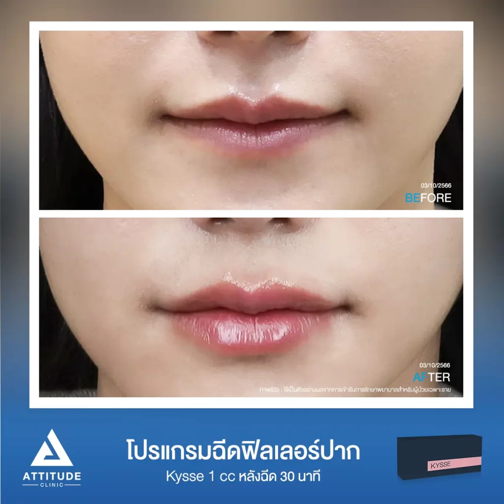 รีวิวโปรแกรมฉีดฟิลเลอร์ปากของคุณวริญญา รุ่น KYSSE จำนวน 1 cc เติมเต็มร่องปากให้อวบอิ่ม ฉ่ำฟู ดูสุขภาพดีที่ 𝗔𝘁𝘁𝗶𝘁𝘂𝗱𝗲 𝗖𝗹𝗶𝗻𝗶𝗰