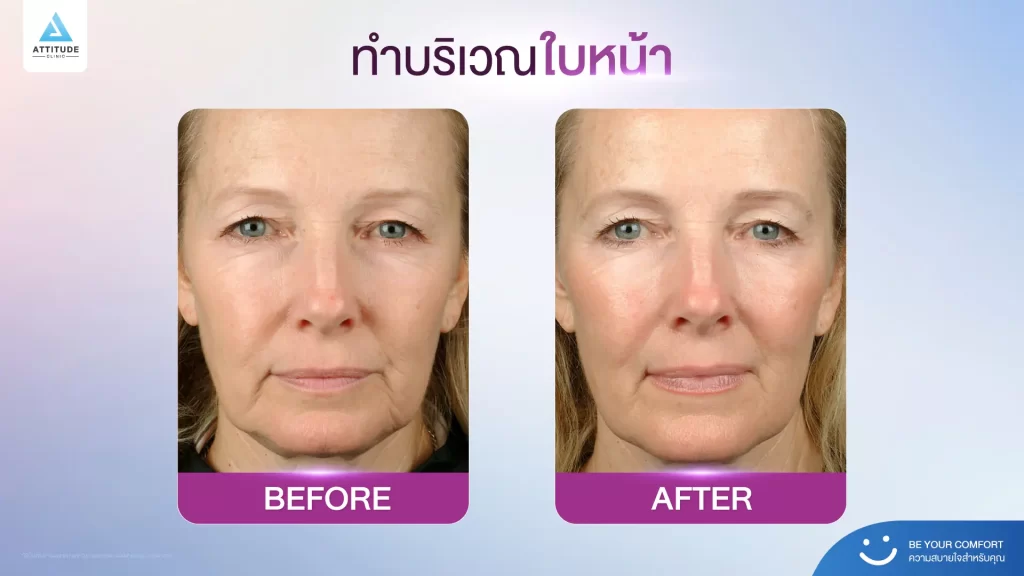 ข้อมูลครบ!! Thermage FLX ที่เชียงราย เทคโนโลยียกกระชับผิวแบบไร้แผล Thermage FLX คืออะไร ?