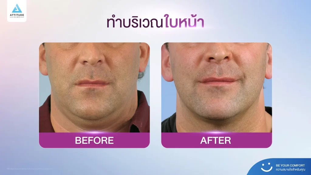 ข้อมูลครบ!! Thermage FLX ที่เชียงราย เทคโนโลยียกกระชับผิวแบบไร้แผล Thermage FLX คืออะไร ?