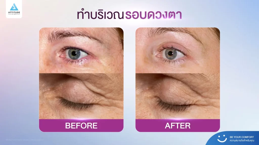 ข้อมูลครบ!! Thermage FLX ที่เชียงราย เทคโนโลยียกกระชับผิวแบบไร้แผล Thermage FLX คืออะไร ?