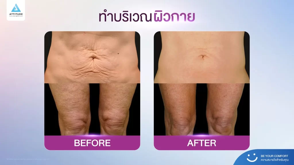 ข้อมูลครบ!! Thermage FLX ที่เชียงราย เทคโนโลยียกกระชับผิวแบบไร้แผล Thermage FLX คืออะไร ?