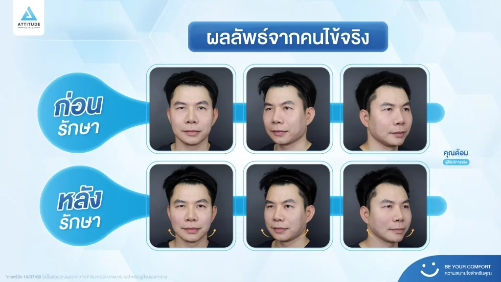 ข้อมูลครบ! Ulthera SPT ก่อนตัดสินใจทำอัลเทอร์ร่า ยกกระชับผิว ปรับรูปหน้า ลดริ้วรอย Ulthera คืออะไร? อัลเทอร์ร่า เหมาะกับใคร? ราคาทำ Ulthera 1 ครั้ง? ทํา Ulthera อยู่ได้นานแค่ไหน? Ulthera เชียงราย อัลเทอร์ร่า เชียงราย เร็วๆ นี้ที่ Attitude Clinic เชียงราย