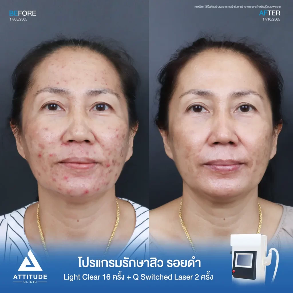 รีวิวรักษาสิวคุณสุวรี ด้วยการฉายแสง Light Clear 7 ขั้นตอน จำนวน 16 ครั้ง และ 𝐐 𝐒𝐰𝐢𝐭𝐜𝐡𝐞𝐝 𝐋𝐚𝐬𝐞𝐫 ลดรอยดำ จำนวน 2 ครั้ง รักษาสิวอักเสบ สิวอุดตันทั่วไปหน้า และรอยสิวโดยเฉพาะรอยดำที่ 𝗔𝘁𝘁𝗶𝘁𝘂𝗱𝗲 𝗖𝗹𝗶𝗻𝗶𝗰