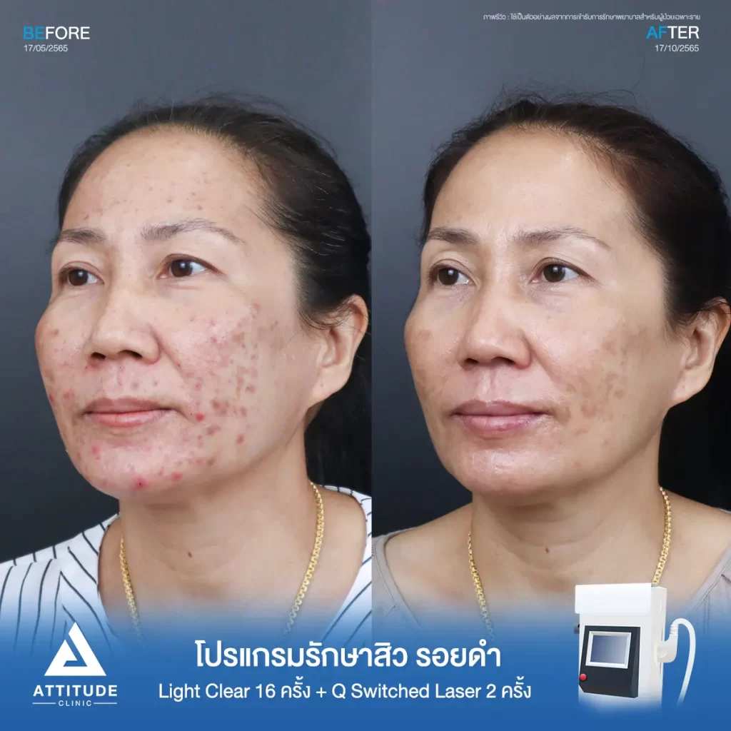 รีวิวรักษาสิวคุณสุวรี ด้วยการฉายแสง Light Clear 7 ขั้นตอน จำนวน 16 ครั้ง และ 𝐐 𝐒𝐰𝐢𝐭𝐜𝐡𝐞𝐝 𝐋𝐚𝐬𝐞𝐫 ลดรอยดำ จำนวน 2 ครั้ง รักษาสิวอักเสบ สิวอุดตันทั่วไปหน้า และรอยสิวโดยเฉพาะรอยดำที่ 𝗔𝘁𝘁𝗶𝘁𝘂𝗱𝗲 𝗖𝗹𝗶𝗻𝗶𝗰