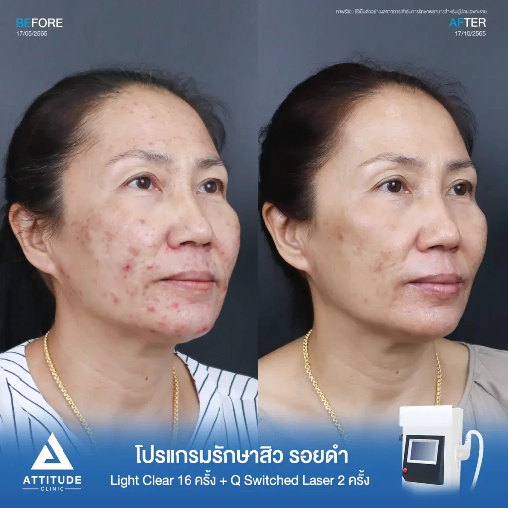 รีวิวรักษาสิวคุณสุวรี ด้วยการฉายแสง Light Clear 7 ขั้นตอน จำนวน 16 ครั้ง และ 𝐐 𝐒𝐰𝐢𝐭𝐜𝐡𝐞𝐝 𝐋𝐚𝐬𝐞𝐫 ลดรอยดำ จำนวน 2 ครั้ง รักษาสิวอักเสบ สิวอุดตันทั่วไปหน้า และรอยสิวโดยเฉพาะรอยดำที่ 𝗔𝘁𝘁𝗶𝘁𝘂𝗱𝗲 𝗖𝗹𝗶𝗻𝗶𝗰