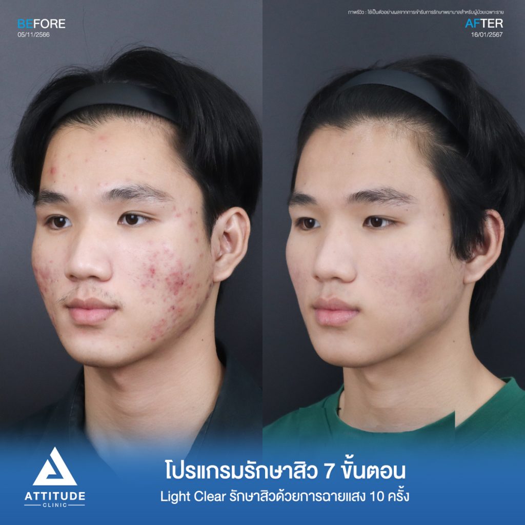 รีวิวรักษาสิวคุณบอม ด้วยการฉายแสง Light Clear 7 ขั้นตอน จำนวน 16 ครั้ง รักษาสิวอักเสบ สิวอุดตันขึ้นเยอะบริเวณสองข้างแก้มที่ 𝗔𝘁𝘁𝗶𝘁𝘂𝗱𝗲 𝗖𝗹𝗶𝗻𝗶𝗰