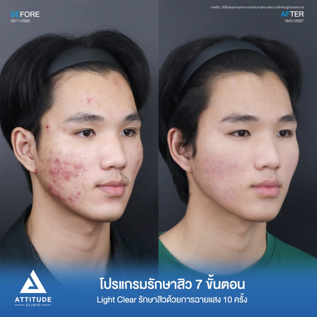 รีวิวรักษาสิวคุณบอม ด้วยการฉายแสง Light Clear 7 ขั้นตอน จำนวน 16 ครั้ง รักษาสิวอักเสบ สิวอุดตันขึ้นเยอะบริเวณสองข้างแก้มที่ 𝗔𝘁𝘁𝗶𝘁𝘂𝗱𝗲 𝗖𝗹𝗶𝗻𝗶𝗰