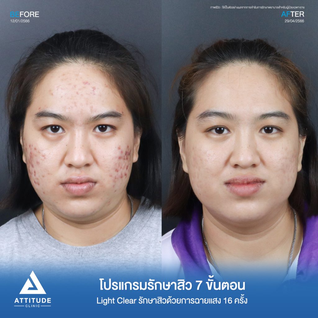 รีวิวรักษาสิวคุณฝน ด้วยการฉายแสง Light Clear 7 ขั้นตอน จำนวน 16 ครั้ง ของคุณฝน รักษาสิวอักเสบ สิวอุดตัน สิวฮอร์โมนเห่อขึ้นช่วงเป็นประจำเดือน โดยเฉพาะบริเวณสองข้างแก้มที่ 𝗔𝘁𝘁𝗶𝘁𝘂𝗱𝗲 𝗖𝗹𝗶𝗻𝗶𝗰