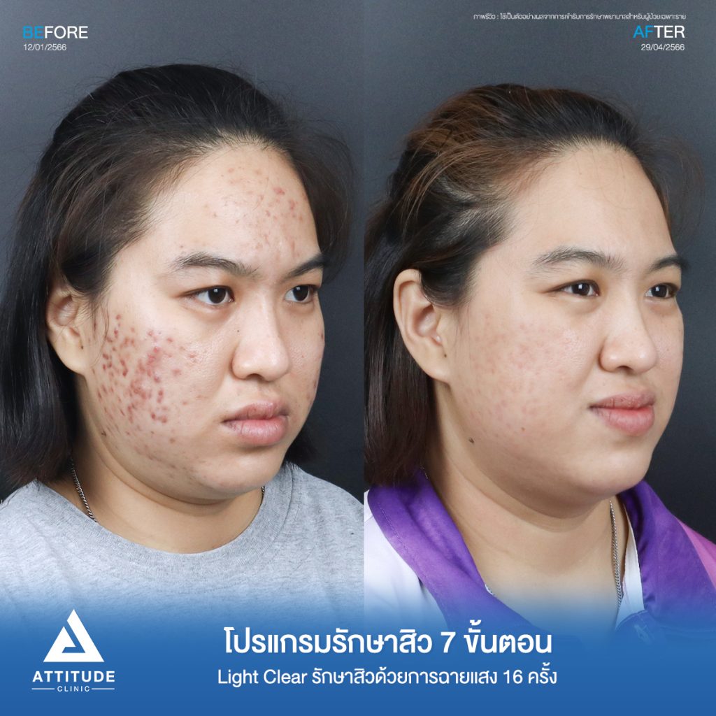 รีวิวรักษาสิวคุณฝน ด้วยการฉายแสง Light Clear 7 ขั้นตอน จำนวน 16 ครั้ง ของคุณฝน รักษาสิวอักเสบ สิวอุดตัน สิวฮอร์โมนเห่อขึ้นช่วงเป็นประจำเดือน โดยเฉพาะบริเวณสองข้างแก้มที่ 𝗔𝘁𝘁𝗶𝘁𝘂𝗱𝗲 𝗖𝗹𝗶𝗻𝗶𝗰