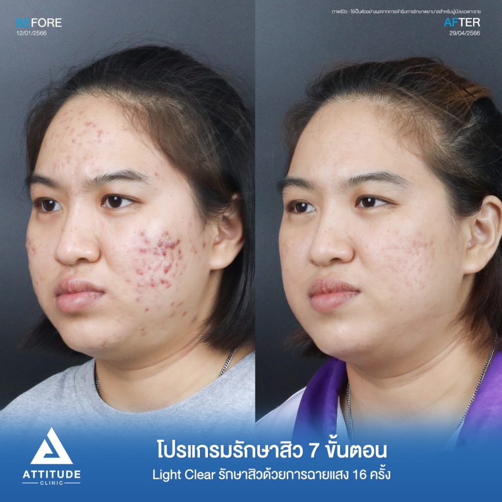 รีวิวรักษาสิวคุณฝน ด้วยการฉายแสง Light Clear 7 ขั้นตอน จำนวน 16 ครั้ง ของคุณฝน รักษาสิวอักเสบ สิวอุดตัน สิวฮอร์โมนเห่อขึ้นช่วงเป็นประจำเดือน โดยเฉพาะบริเวณสองข้างแก้มที่ 𝗔𝘁𝘁𝗶𝘁𝘂𝗱𝗲 𝗖𝗹𝗶𝗻𝗶𝗰