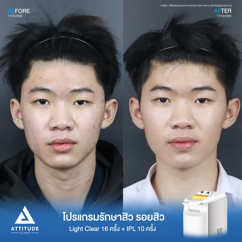 รีวิวรักษาสิวคุณบูม ด้วยการฉายแสง Light Clear 7 ขั้นตอน จำนวน 16 ครั้ง และทำ IPL หน้าใส ลดรอยสิว จำนวน 10 ครั้ง รักษาสิวอักเสบ สิวอุดตัน และรอยแดงจากสิวบริเวณ 2 ข้างแก้ม จนถึงช่วงคาง และคอที่ 𝗔𝘁𝘁𝗶𝘁𝘂𝗱𝗲 𝗖𝗹𝗶𝗻𝗶𝗰