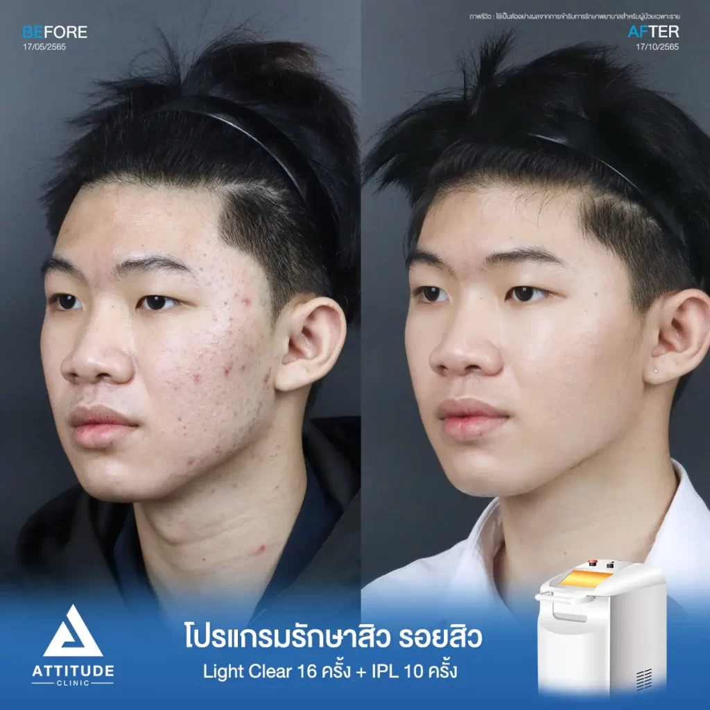 รีวิวรักษาสิวคุณบูม ด้วยการฉายแสง Light Clear 7 ขั้นตอน จำนวน 16 ครั้ง และทำ IPL หน้าใส ลดรอยสิว จำนวน 10 ครั้ง รักษาสิวอักเสบ สิวอุดตัน และรอยแดงจากสิวบริเวณ 2 ข้างแก้ม จนถึงช่วงคาง และคอที่ 𝗔𝘁𝘁𝗶𝘁𝘂𝗱𝗲 𝗖𝗹𝗶𝗻𝗶𝗰