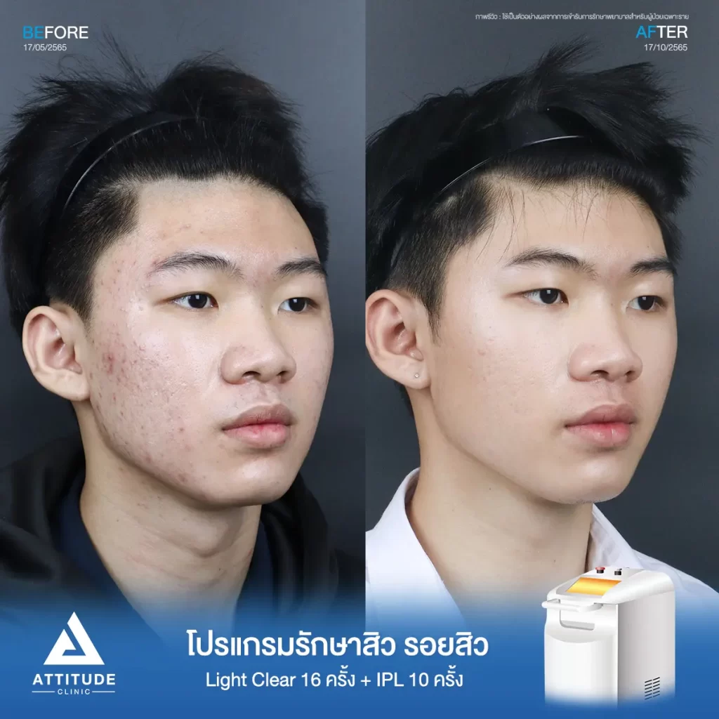 รีวิวรักษาสิวคุณบูม ด้วยการฉายแสง Light Clear 7 ขั้นตอน จำนวน 16 ครั้ง และทำ IPL หน้าใส ลดรอยสิว จำนวน 10 ครั้ง รักษาสิวอักเสบ สิวอุดตัน และรอยแดงจากสิวบริเวณ 2 ข้างแก้ม จนถึงช่วงคาง และคอที่ 𝗔𝘁𝘁𝗶𝘁𝘂𝗱𝗲 𝗖𝗹𝗶𝗻𝗶𝗰