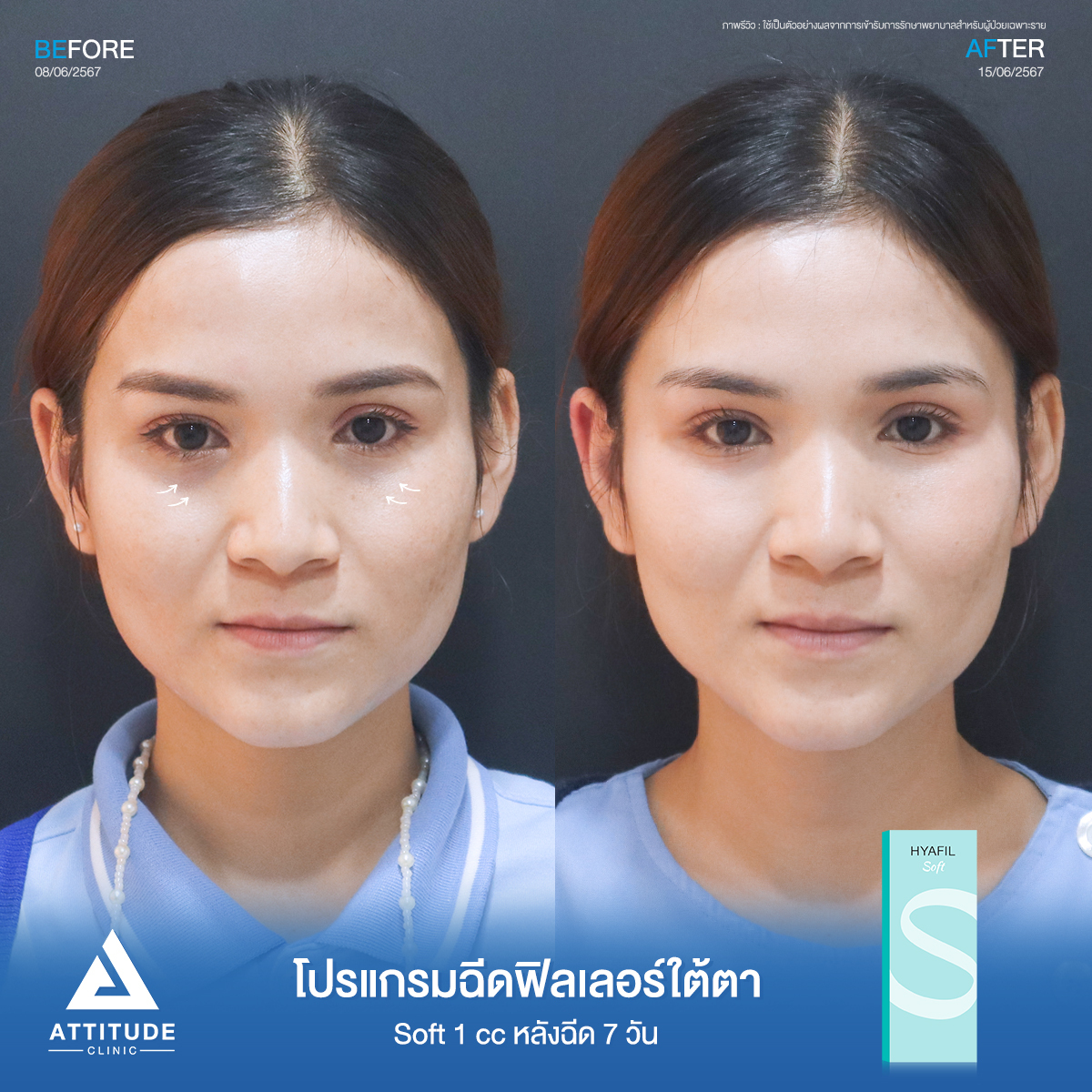 รีวิวฉีดฟิลเลอร์ใต้ตา Hyafilia S