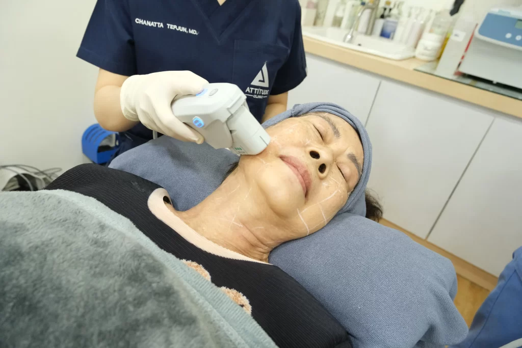 ข้อมูลครบ! Ulthera SPT ก่อนตัดสินใจทำอัลเทอร์ร่า ยกกระชับผิว ปรับรูปหน้า ลดริ้วรอย Ulthera คืออะไร? อัลเทอร์ร่า เหมาะกับใคร? ราคาทำ Ulthera 1 ครั้ง? ทํา Ulthera อยู่ได้นานแค่ไหน? Ulthera เชียงราย อัลเทอร์ร่า เชียงราย เร็วๆ นี้ที่ Attitude Clinic เชียงราย