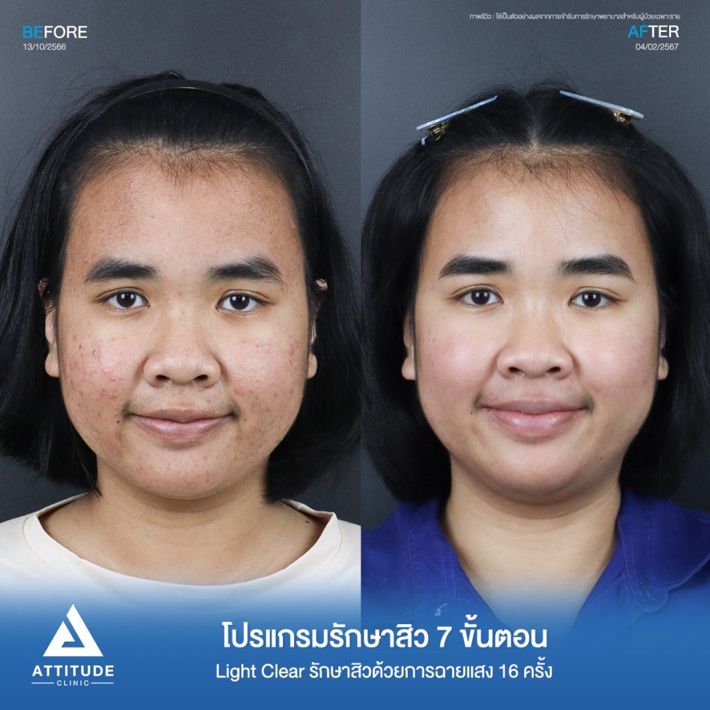 รีวิวรักษาสิวคุณเอิร์น ด้วยการฉายแสง Light Clear 7 ขั้นตอน จำนวน 16 ครั้ง รักษาสิวอักเสบ สิวอุดตันเม็ดเล็กๆทั่วใบหน้าที่ 𝗔𝘁𝘁𝗶𝘁𝘂𝗱𝗲 𝗖𝗹𝗶𝗻𝗶𝗰