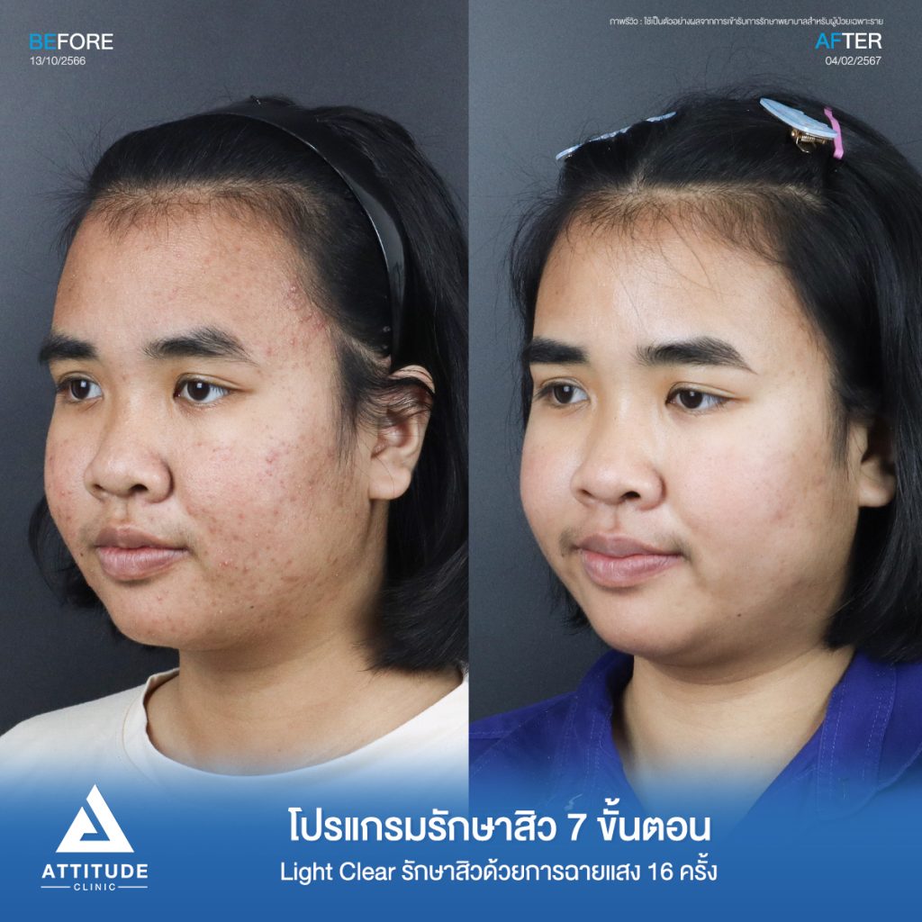 รีวิวรักษาสิวคุณเอิร์น ด้วยการฉายแสง Light Clear 7 ขั้นตอน จำนวน 16 ครั้ง รักษาสิวอักเสบ สิวอุดตันเม็ดเล็กๆทั่วใบหน้าที่ 𝗔𝘁𝘁𝗶𝘁𝘂𝗱𝗲 𝗖𝗹𝗶𝗻𝗶𝗰