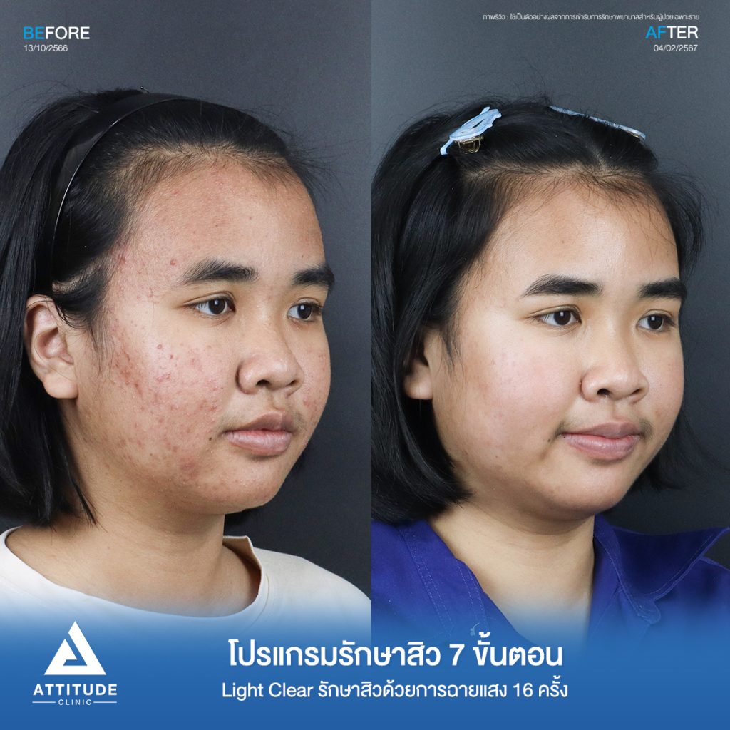 รีวิวรักษาสิวคุณเอิร์น ด้วยการฉายแสง Light Clear 7 ขั้นตอน จำนวน 16 ครั้ง รักษาสิวอักเสบ สิวอุดตันเม็ดเล็กๆทั่วใบหน้าที่ 𝗔𝘁𝘁𝗶𝘁𝘂𝗱𝗲 𝗖𝗹𝗶𝗻𝗶𝗰