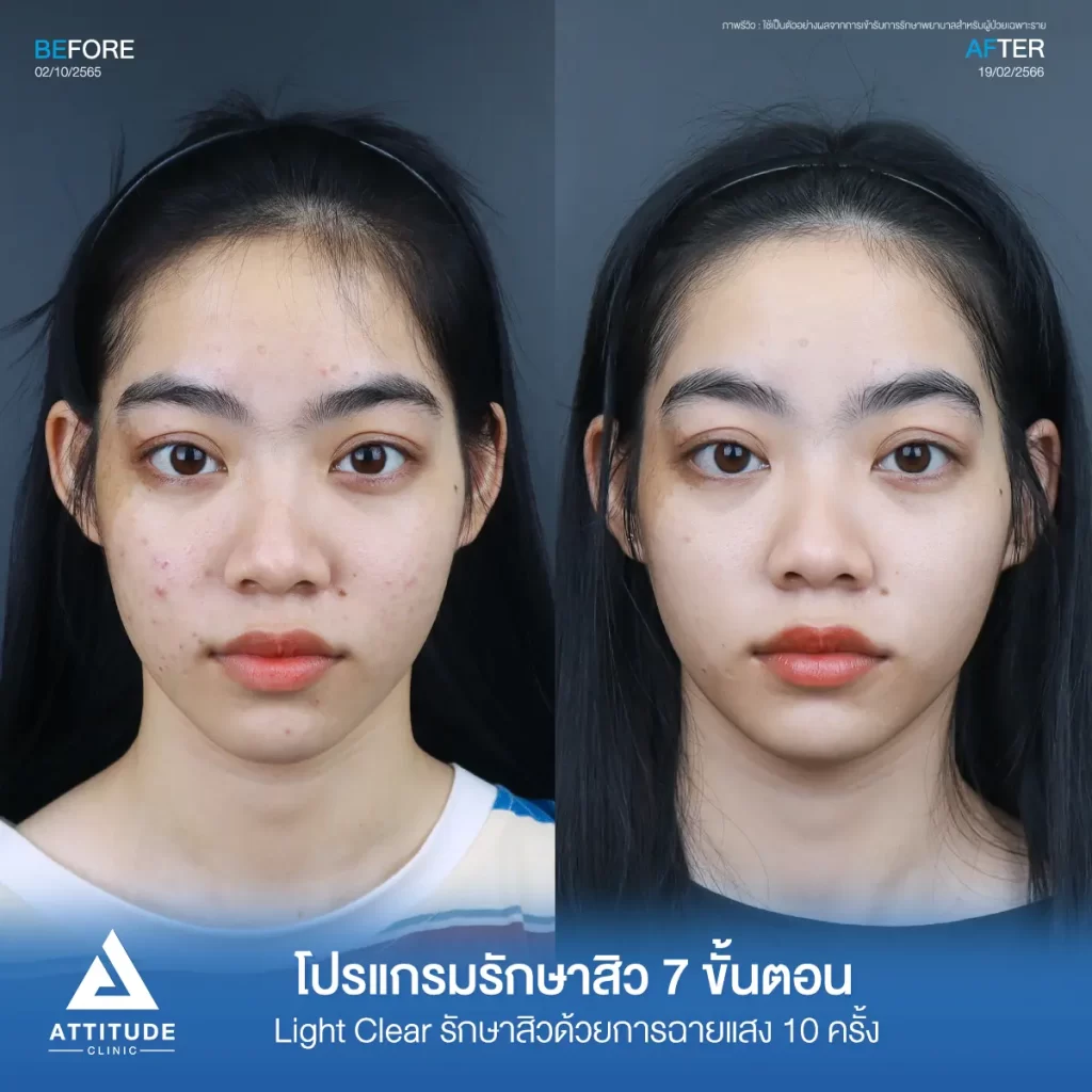 รีวิวรักษาสิวคุณณัฏฐณิชา โปรแกรมรักษาสิว 7 ขั้นตอน Light Clear รักษาสิวด้วยการฉายแสง จำนวน 10 ครั้ง รักษาสิวอักเสบ สิวอุดตัน สิวฮอร์โมน รอยสิวกวนใจ