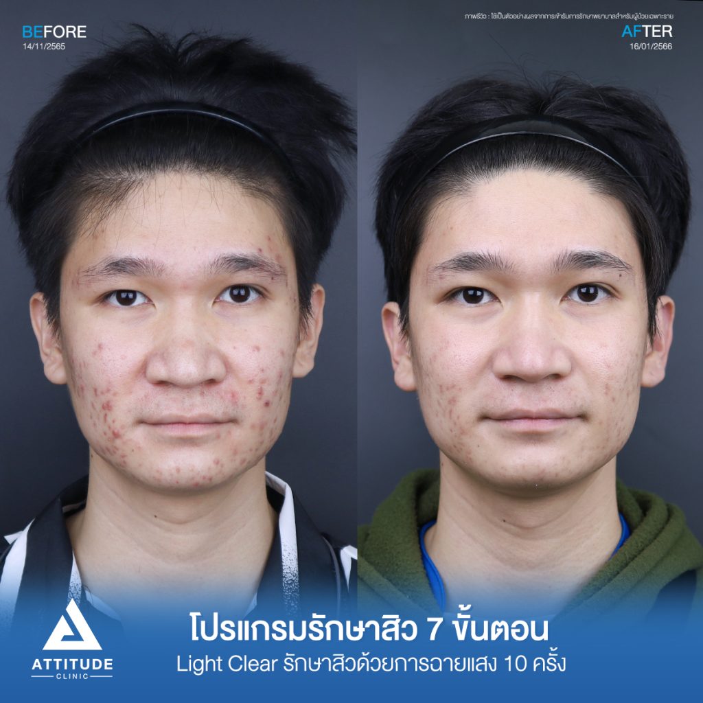 รีวิวรักษาสิวคุณฝน ด้วยการฉายแสง Light Clear 7 ขั้นตอน จำนวน 16 ครั้ง ของคุณฝน รักษาสิวอักเสบ สิวอุดตัน สิวฮอร์โมนเห่อขึ้นช่วงเป็นประจำเดือน โดยเฉพาะบริเวณสองข้างแก้มที่ 𝗔𝘁𝘁𝗶𝘁𝘂𝗱𝗲 𝗖𝗹𝗶𝗻𝗶𝗰