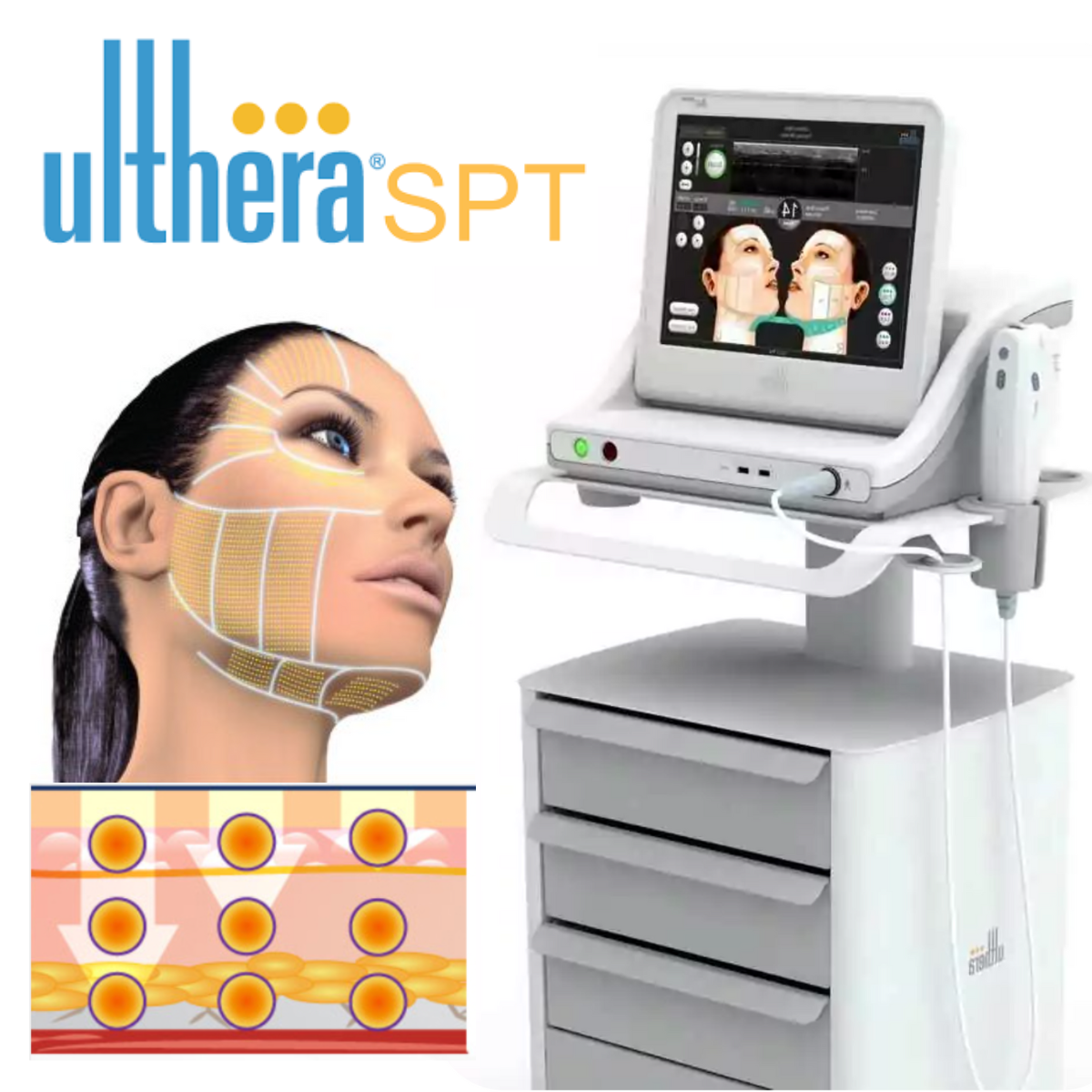 Ulthera Ruler ข้อมูลครบ! Ulthera SPT ก่อนตัดสินใจทำอัลเทอร์ร่า ยกกระชับผิว ปรับรูป ...