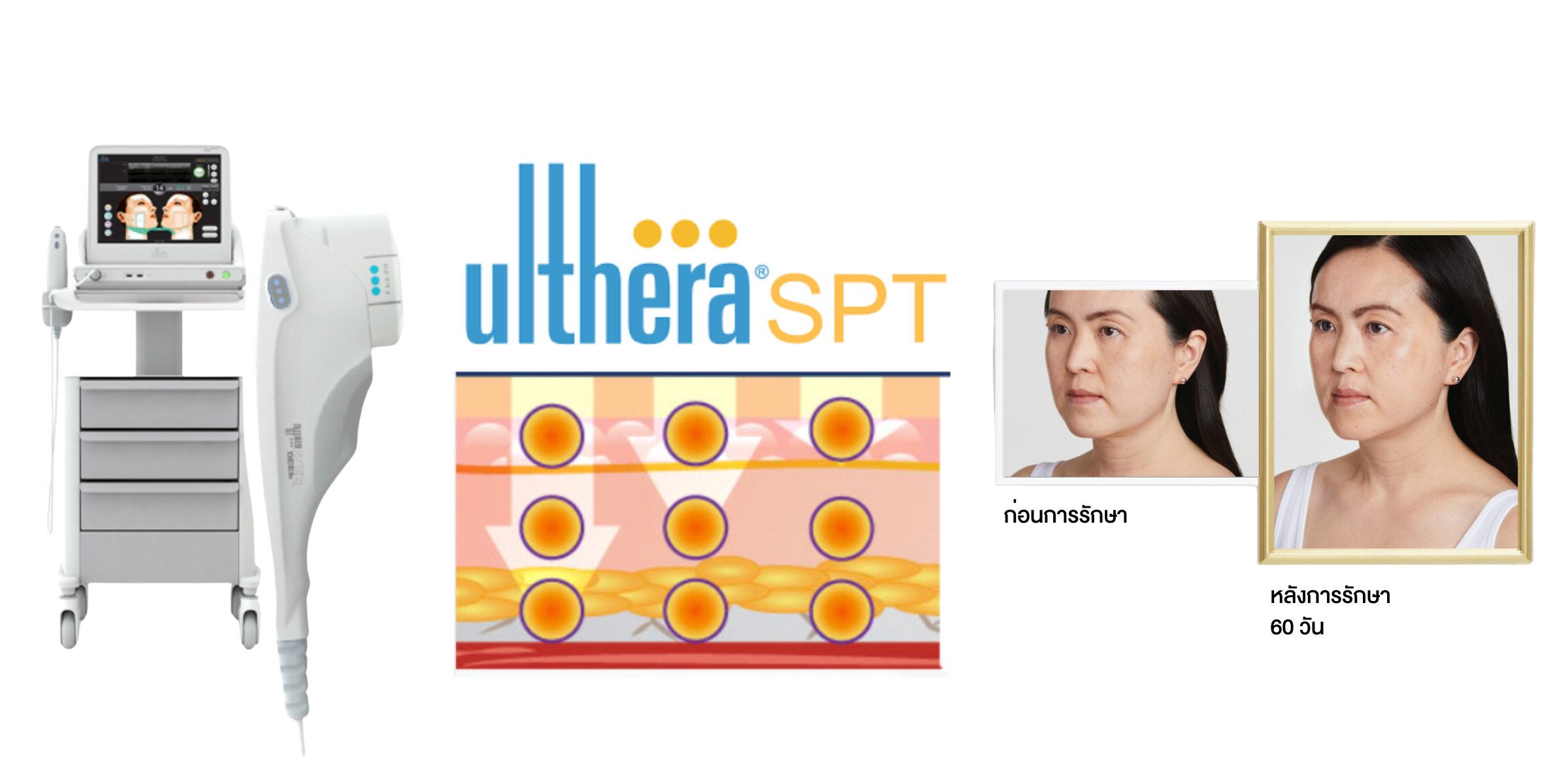 รวมข้อมูล! Ulthera SPT ก่อนตัดสินใจทำอัลเทอร์ร่า ยกกระชับผิว ปรับรูปหน้า ลดริ้วรอย Ulthera คืออะไร? อัลเทอร์ร่า เหมาะกับใคร? ราคาทำ Ulthera? ทํา Ulthera อยู่ได้นานแค่ไหน? Ulthera เชียงราย อัลเทอร์ร่า เชียงราย