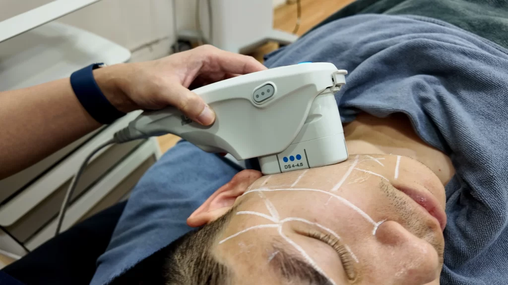 ข้อมูลครบ! Ulthera SPT ก่อนตัดสินใจทำอัลเทอร์ร่า ยกกระชับผิว ปรับรูปหน้า ลดริ้วรอย Ulthera คืออะไร? อัลเทอร์ร่า เหมาะกับใคร? ราคาทำ Ulthera 1 ครั้ง? ทํา Ulthera อยู่ได้นานแค่ไหน? Ulthera เชียงราย อัลเทอร์ร่า เชียงราย เร็วๆ นี้ที่ Attitude Clinic เชียงราย