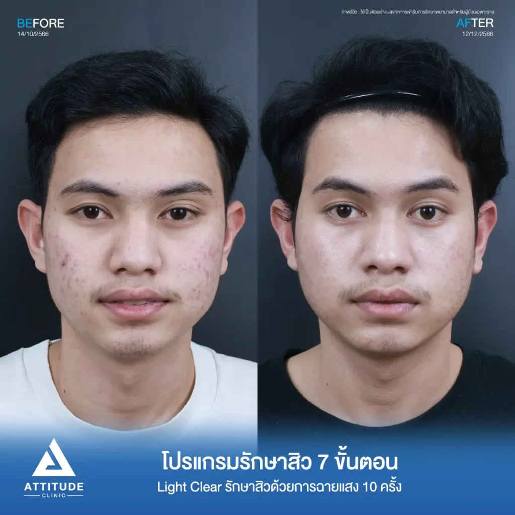 รีวิวรักษาสิวคุณฟีร์ ด้วยการฉายแสง Light Clear 7 ขั้นตอน จำนวน 10 ครั้ง รักษาสิวอักเสบ สิวอุดตัน บริเวณสองข้างแก้มที่ 𝗔𝘁𝘁𝗶𝘁𝘂𝗱𝗲 𝗖𝗹𝗶𝗻𝗶𝗰