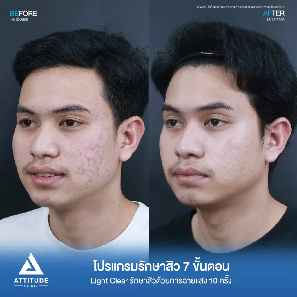 รีวิวรักษาสิวคุณฟีร์ ด้วยการฉายแสง Light Clear 7 ขั้นตอน จำนวน 10 ครั้ง รักษาสิวอักเสบ สิวอุดตัน บริเวณสองข้างแก้มที่ 𝗔𝘁𝘁𝗶𝘁𝘂𝗱𝗲 𝗖𝗹𝗶𝗻𝗶𝗰