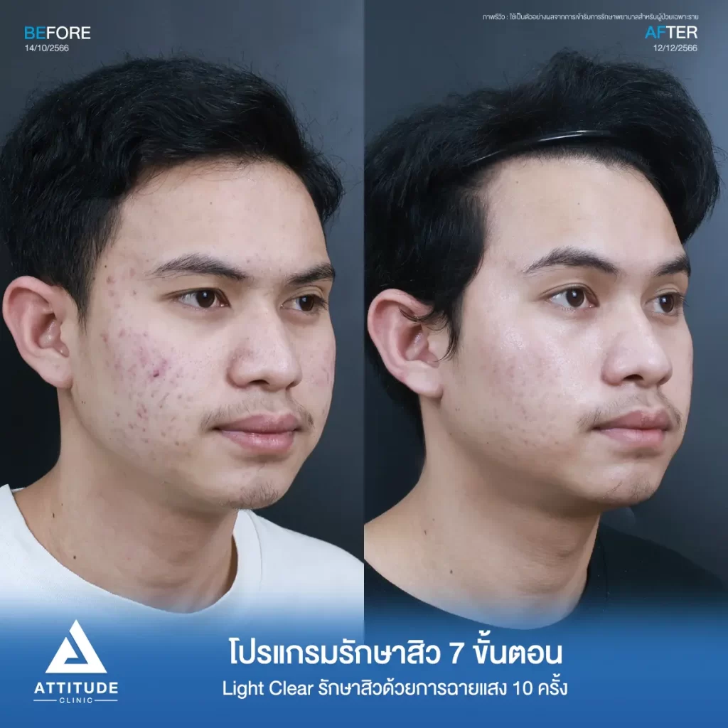 รีวิวรักษาสิวคุณฟีร์ ด้วยการฉายแสง Light Clear 7 ขั้นตอน จำนวน 10 ครั้ง รักษาสิวอักเสบ สิวอุดตัน บริเวณสองข้างแก้มที่ 𝗔𝘁𝘁𝗶𝘁𝘂𝗱𝗲 𝗖𝗹𝗶𝗻𝗶𝗰