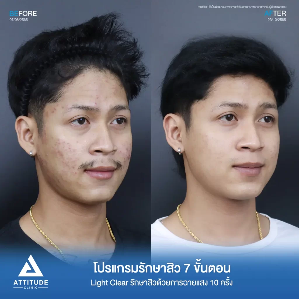 รีวิวรักษาสิวคุณเดียร์ ด้วยการฉายแสง Light Clear 7 ขั้นตอน จำนวน 10 ครั้ง รักษาสิวอักเสบ สิวอุดตัน ทั่วใบหน้าที่ Attitude Clinic