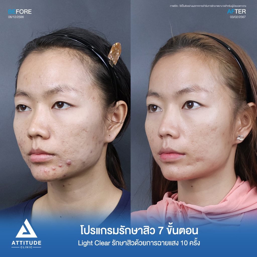 รีวิวรักษาสิวคุณอำไพ ด้วยการฉายแสง Light Clear 7 ขั้นตอน จำนวน 10 ครั้ง รักษาสิวอักเสบ สิวหัวหนอง ขึ้นเยอะบริเวณคาง ลามจนถึงคอที่ 𝗔𝘁𝘁𝗶𝘁𝘂𝗱𝗲 𝗖𝗹𝗶𝗻𝗶𝗰