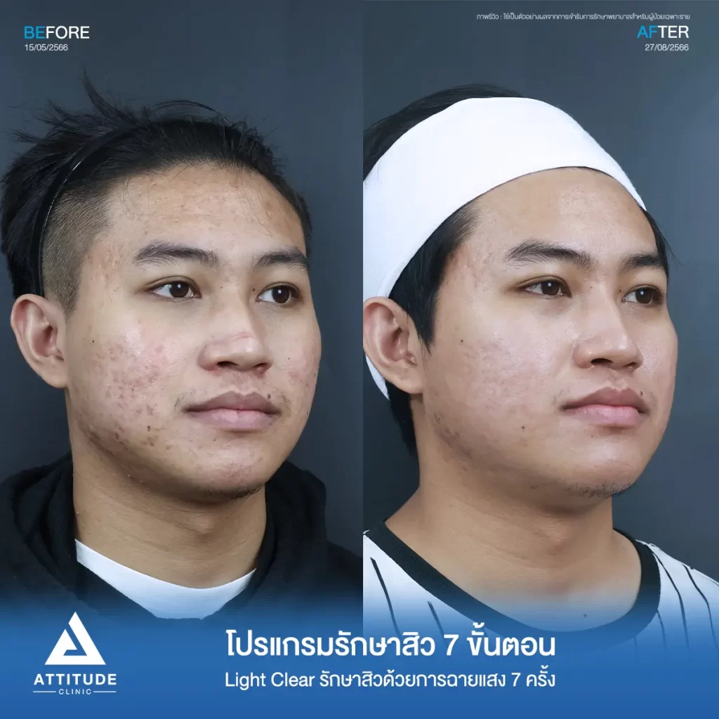 รีวิวรักษาสิวคุณนนท์ ด้วยการฉายแสง Light Clear 7 ขั้นตอน จำนวน 7 ครั้ง ของคุณนนท์ รักษาสิวอุดตัน สิวผด และรอยสิวทั่วใบหน้าที่ Attitude Clinic