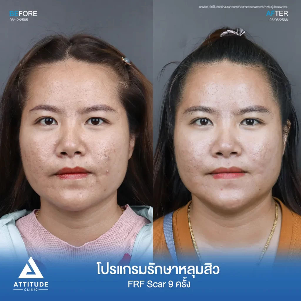 รีวิวรักษาหลุมสิวคุณกนกวรรณ FRF Scar จำนวน 9 ครั้ง รักษาหลุมสิว กระชับรูขุมขนทั่วใบหน้า โดยเฉพาะบริเวณหน้าแก้ม 2 ข้าง และหน้าผากที่ Attitude Clinic