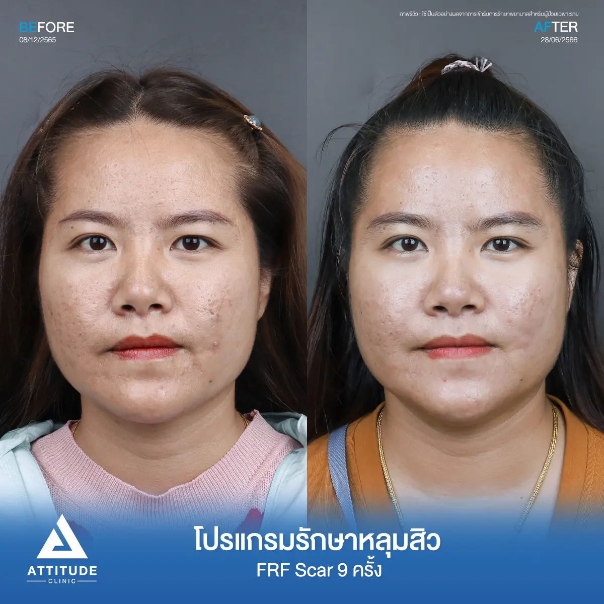 รีวิวรักษาหลุมสิวคุณกนกวรรณ FRF Scar จำนวน 9 ครั้ง รักษาหลุมสิว กระชับรูขุมขนทั่วใบหน้า โดยเฉพาะบริเวณหน้าแก้ม 2 ข้าง และหน้าผากที่ Attitude Clinic