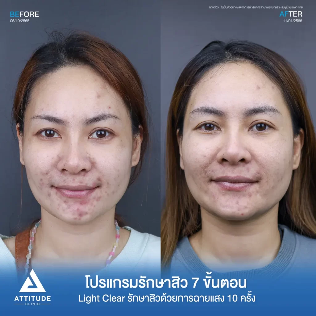 รีวิวรักษาสิวคุณหนึ่ง ด้วยการฉายแสง Light Clear 7 ขั้นตอน จำนวน 10 ครั้ง รักษาสิวอักเสบ สิวอุดตัน รอยแดงที่ขึ้นเยอะบริเวณรอบริมฝีปาก และคางที่ Attitude Clinic