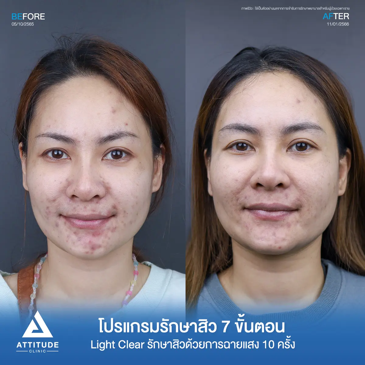 รีวิวรักษาสิวคุณหนึ่ง ด้วยการฉายแสง Light Clear 7 ขั้นตอน จำนวน 10 ครั้ง รักษาสิวอักเสบ สิวอุดตัน รอยแดงที่ขึ้นเยอะบริเวณรอบริมฝีปาก และคางที่ Attitude Clinic