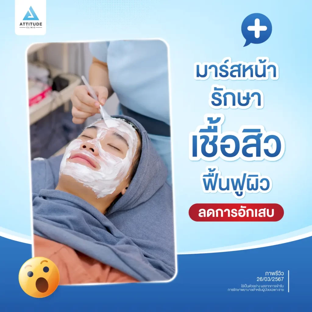 รักษาสิว 7 ขั้นตอน โปรแกรม Light Clear ฉายแสงรักษาสิวอักเสบ สิวอุดตัน สิวผด สิวแพ้ สิวสเตียรอยด์ สิวไหนๆ เราก็ใส่ใจรักษา คุณหมอประเมินพยายามแก้ปัญหาสิวที่ต้นเหตุ ฟื้นฟูผิวให้แข็งแรงสู้กับปัญหาสิว