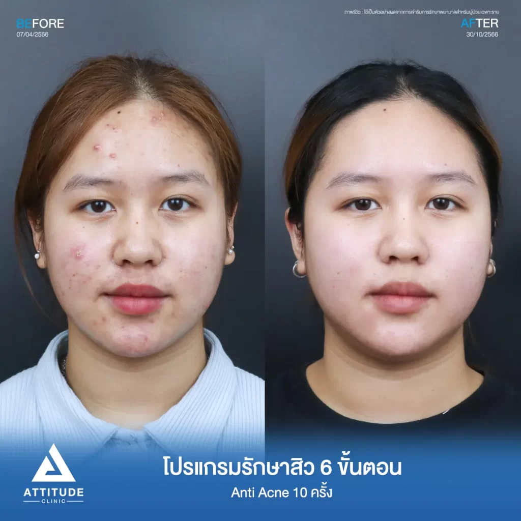 รีวิวรักษาสิวคุณปภาวี ด้วยโปรแกรม Anti Acne 6 ขั้นตอน จำนวน 10 ครั้ง รักษาสิวอักเสบ สิวอุดตัน รอยแดงทั่วใบหน้าที่ Attitude Clinic