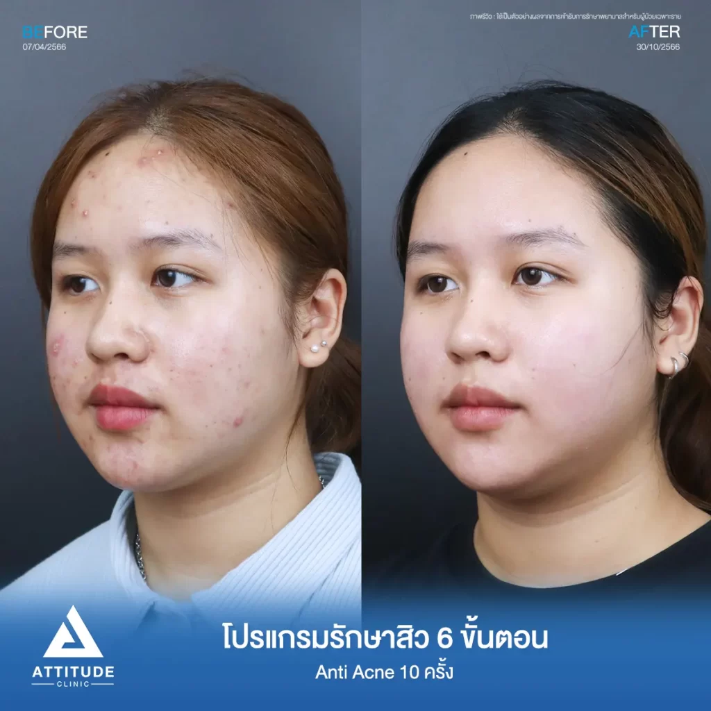 รีวิวรักษาสิวคุณปภาวี ด้วยโปรแกรม Anti Acne 6 ขั้นตอน จำนวน 10 ครั้ง รักษาสิวอักเสบ สิวอุดตัน รอยแดงทั่วใบหน้าที่ Attitude Clinic